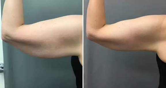 arms coolsculpting before after