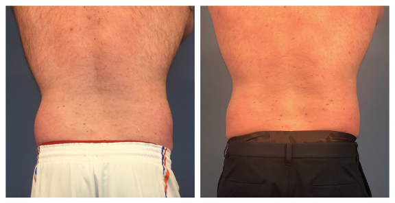 before-after-coolsculpting-love-handles