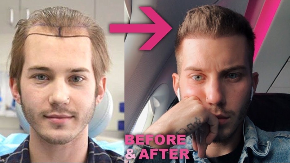 before and after hair transplant surgery