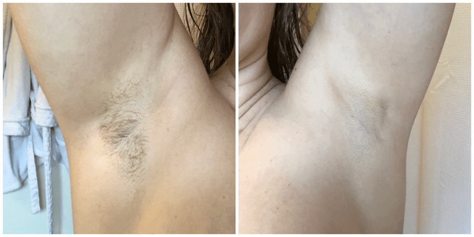 laser hair removal before and after