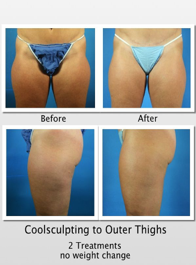 outer thigh coolsculpting