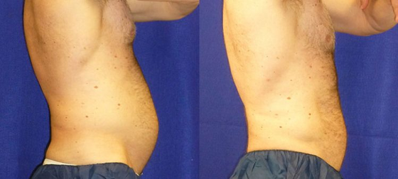 stomach before and after coolsculpting