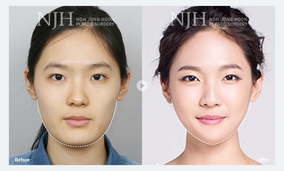 Banobagi #Plasticsurgery #Cosmeticsurgery #Beauty #Women #Gangnam