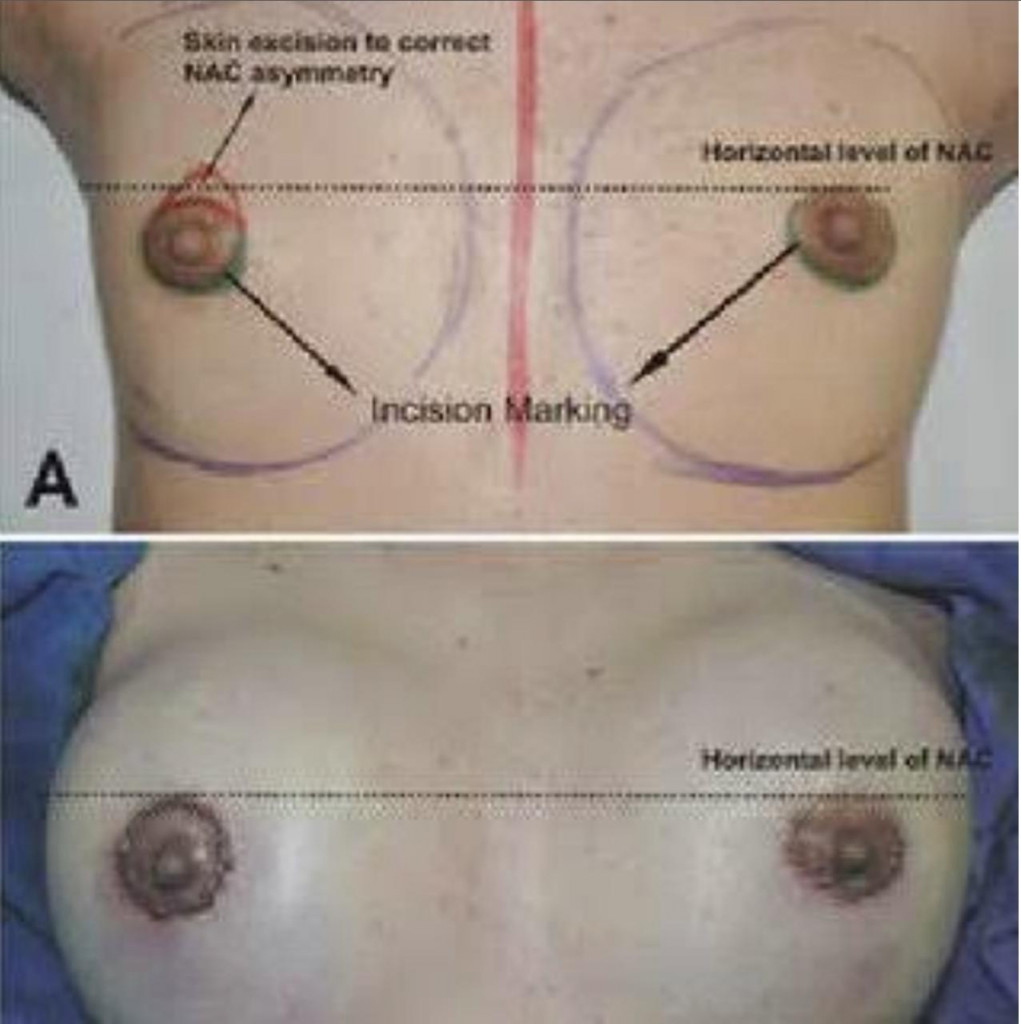 Periareolar incision