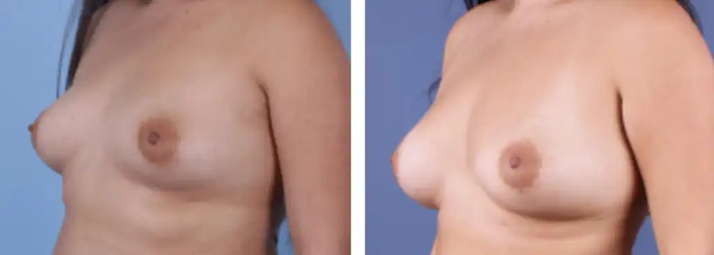 Breast augmentation via lipofilling using 600cc fat.