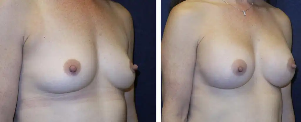 Breast augmentation using Ideal implants. 