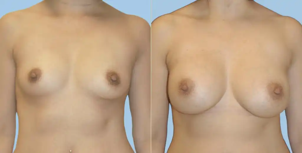 Breast augmentation using round silicone implants via subglandular technique.