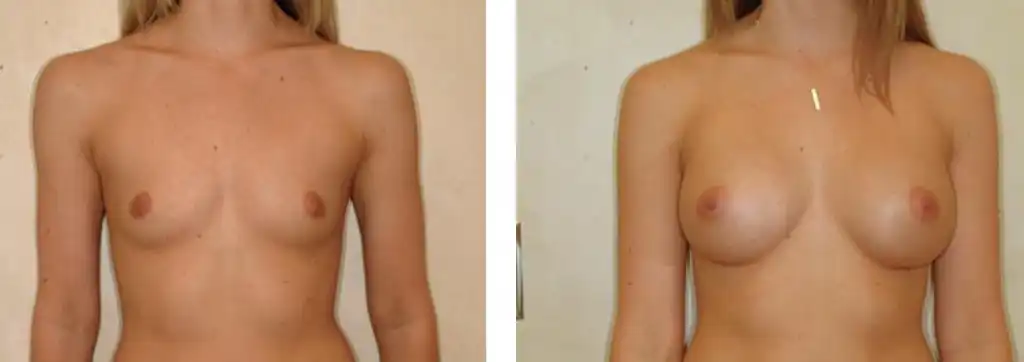 Breast augmentation using 300cc saline implants inflated to 350cc.