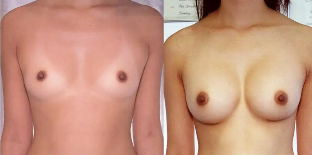 Breast augmentation using 200cc round implants via subpectoral technique. 