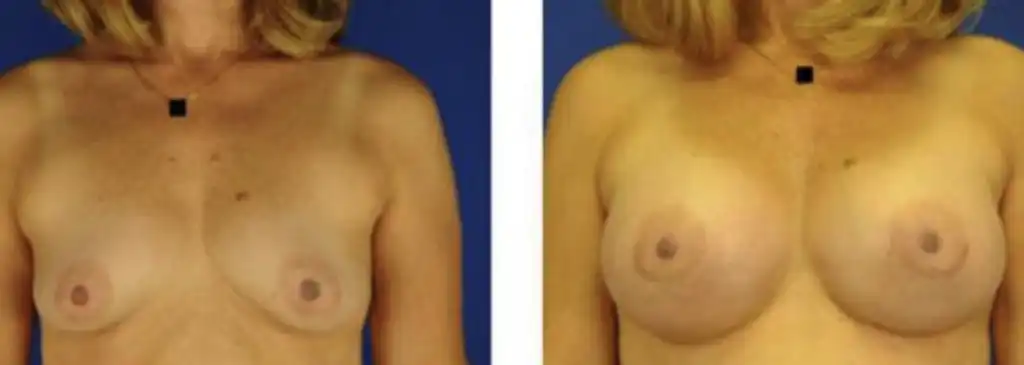 Breast augmentation using saline implants with different sizes placed below the muscle via periareolar incision.