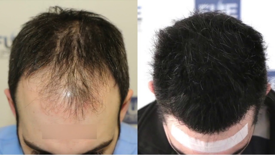 fue hair transplant