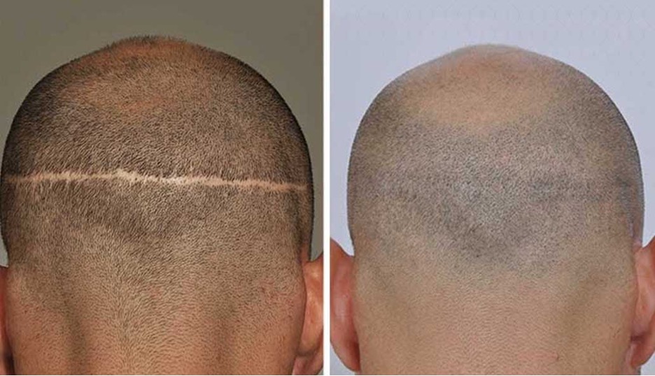 fut hair transplant