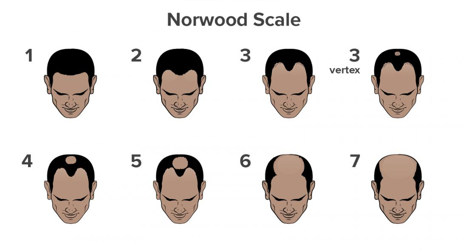 norwood balding scale