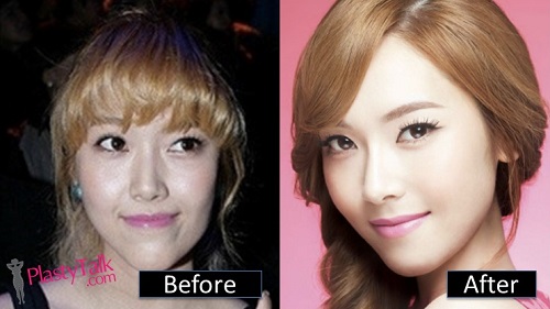 Jessica-Jung-SNSD-Plastic-Surgery