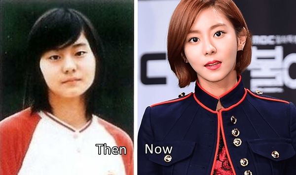 uee before after plastic surgery