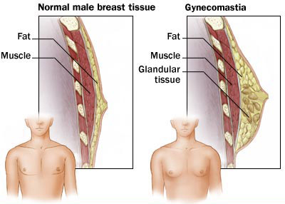 Gynecomastia diagram of what it is