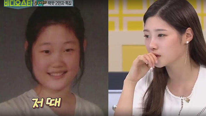 Jung ChaeYeon plastic surgery on nose before and after