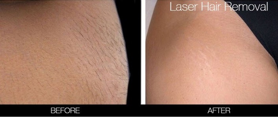 brazillian hair removal