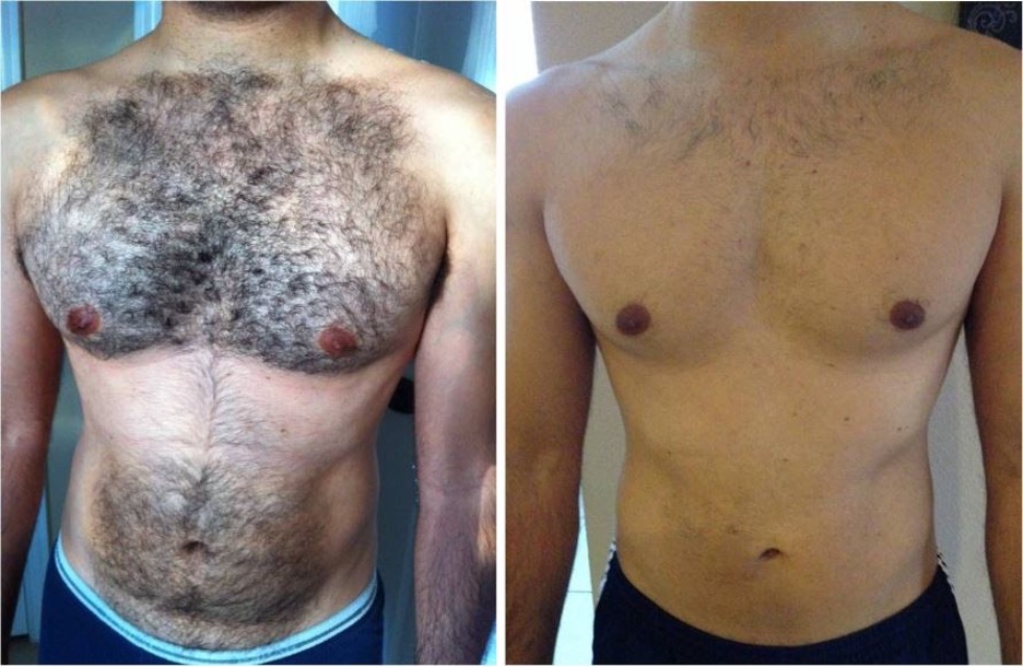 men chest laser hair